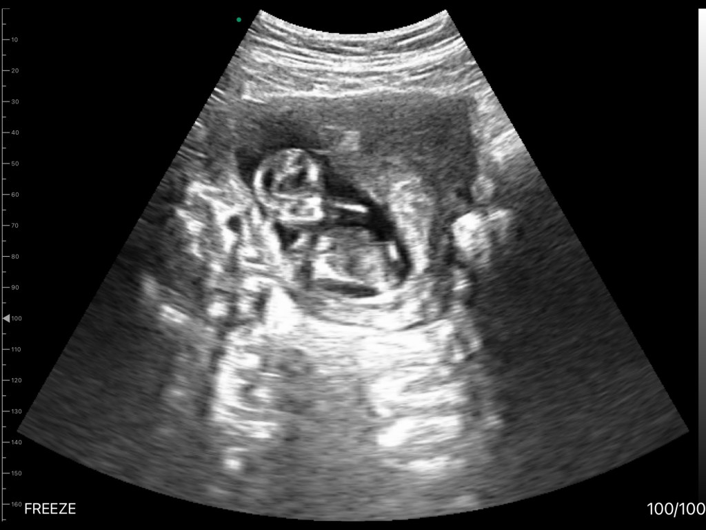 12 week ultrasound image
