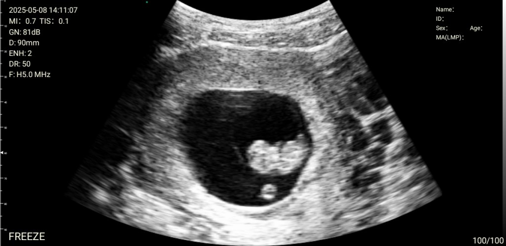 9 week ultrasound image